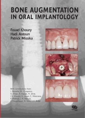 Bone Augmentation in Oral Implantology 1st edition