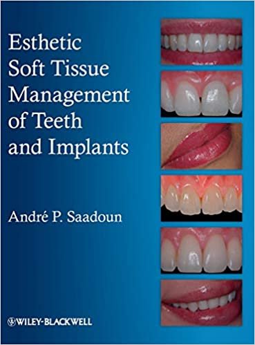 Esthetic Soft Tissue Management Of Teeth And Implants 1st edition