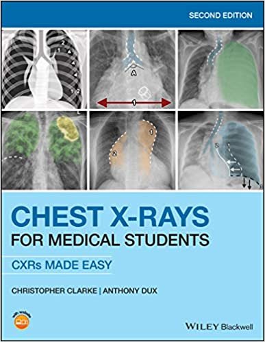 Chest X-Rays for Medical Students CXRs Made Easy 2nd edition