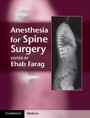Anesthesia for Spine Surgery 1st edition
