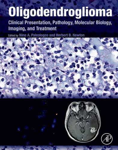 Oligodendroglioma: Clinical Presentation, Pathology, Molecular Biology, Imaging, and Treatment