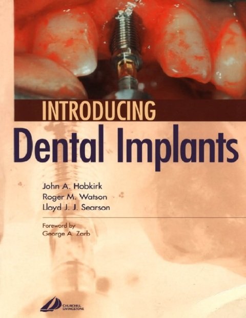Introducing Dental Implants.