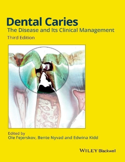 Dental Caries The Disease and its Clinical Management.