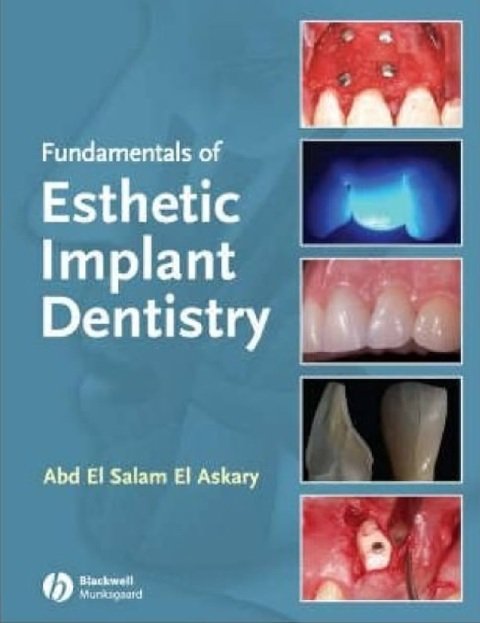 Fundamentals of Esthetic Implant Dentistry.