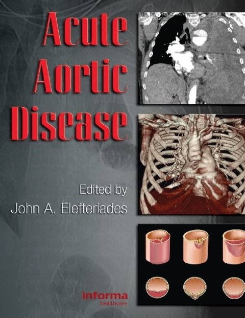 Acute Aortic Disease (Fundamental and Clinical Cardiology.