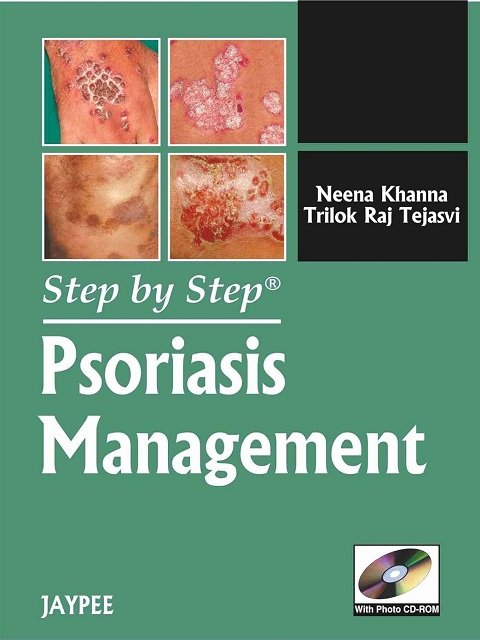 Psoriasis Management (Step by Step)