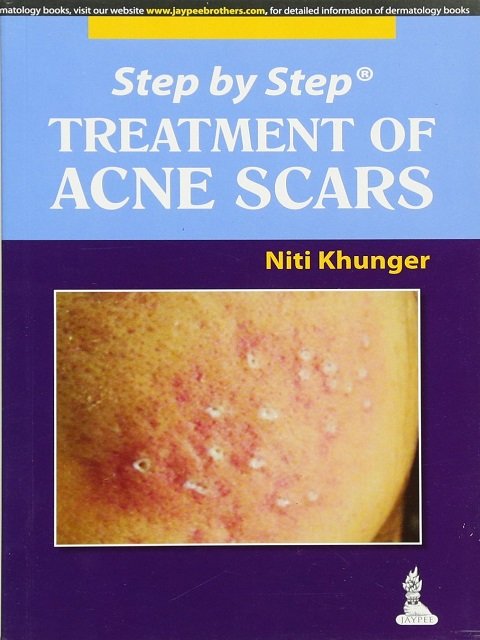 Step by Step Treatment of Acne Scars