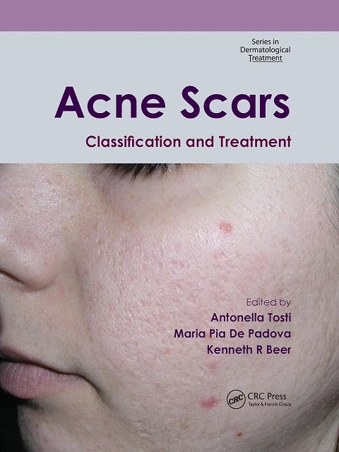 Acne Scars Classification and Treatment (Series in Dermatological Treatment)