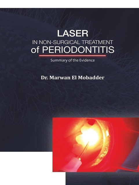 Laser in Non-Surgical Treatment of Periodontitis Summary of the Evidence, Simply Explained