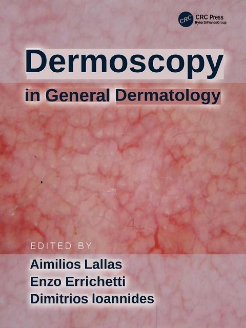 Dermoscopy in General Dermatology